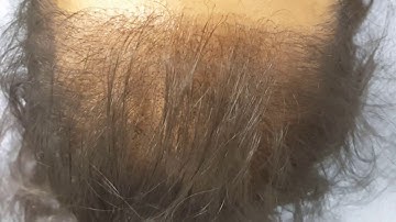 Female Thinning Hair Scalp Micropigmentation SMP 1st session by El Truchan @ Scalp Micro Definition