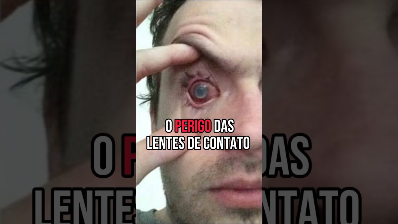 RISCOS OCULARES: Uso Incorreto de Lentes de Contato! #optometrista #optometria #miopia