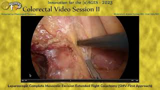 Laparoscopic Complete Mesocolic Excision Extended Right Colectomy (SMV-First Approach)