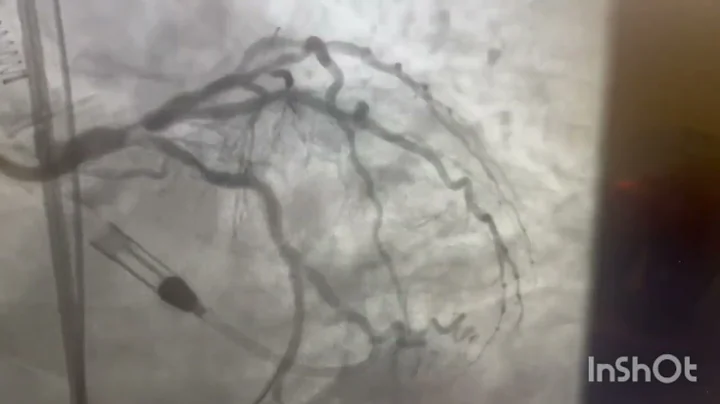 PCI to LMS to CIRC | intra aortic balloon pump| Trifurcation lesion 