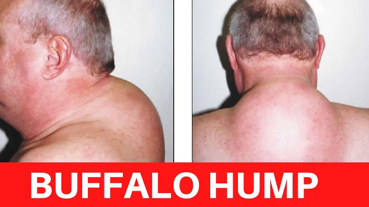 Are buffalo humps genetic? (2023)
