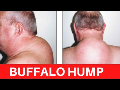 Dowager's Hump - Causes, Symptoms & Treatment– Bauerfeind Australia