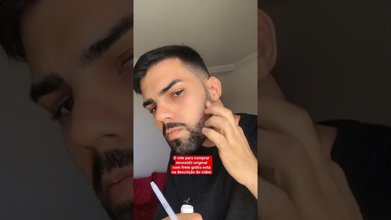Como usar o minoxidil corretamente! 