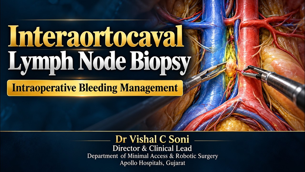 Inter Aorto-Caval Lymph node Biopsy with Bleed Management - YouTube