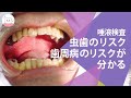 唾液検査で虫歯や歯周病のリスクがわかる! サリバテストで虫歯や歯周病を予防する Check Periodontal Disease and Tooth Decay With Saliva Test