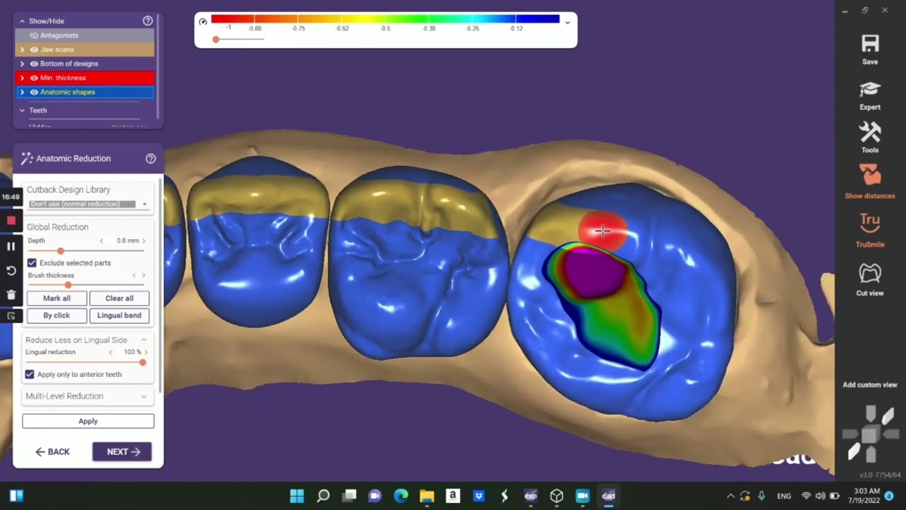 EXOCAD || 5-Unit bridge (cut back)