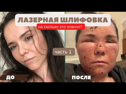 ЛАЗЕРНАЯ ШЛИФОВКА, моя история. Лазерная шлифовка лица CO2 лазером (ЧАСТЬ 1).