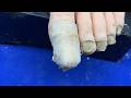 Ingrown toenails with onychomycosis, toenails have fungus black mud 4547