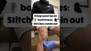 11 Days Post Op Knee Surgery: stitches are out!