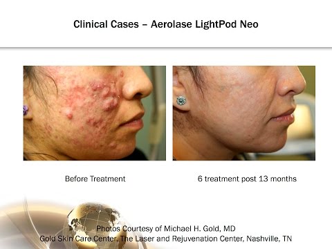 Moderate to Cystic Acne:  Treatment Advancements with -microsecond Laser Technology