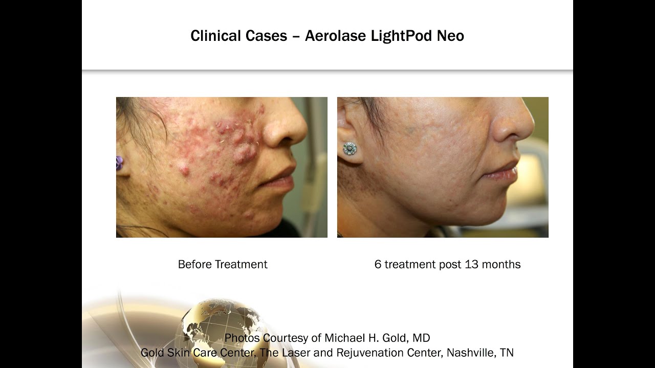 Moderate to Cystic Acne Treatment Advancements with 650microsecond
