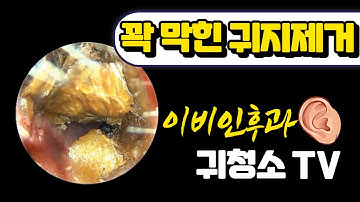 꽉 막힌 귀지제거 (ear wax removal)