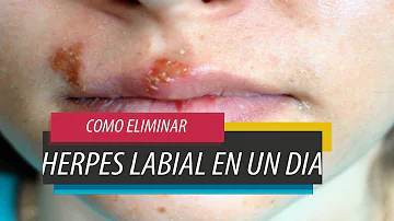 ¿Ayuda el bicarbonato al herpes labial?