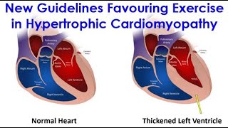 New Guidelines Favouring Exercise in Hypertrophic Cardiomyopathy