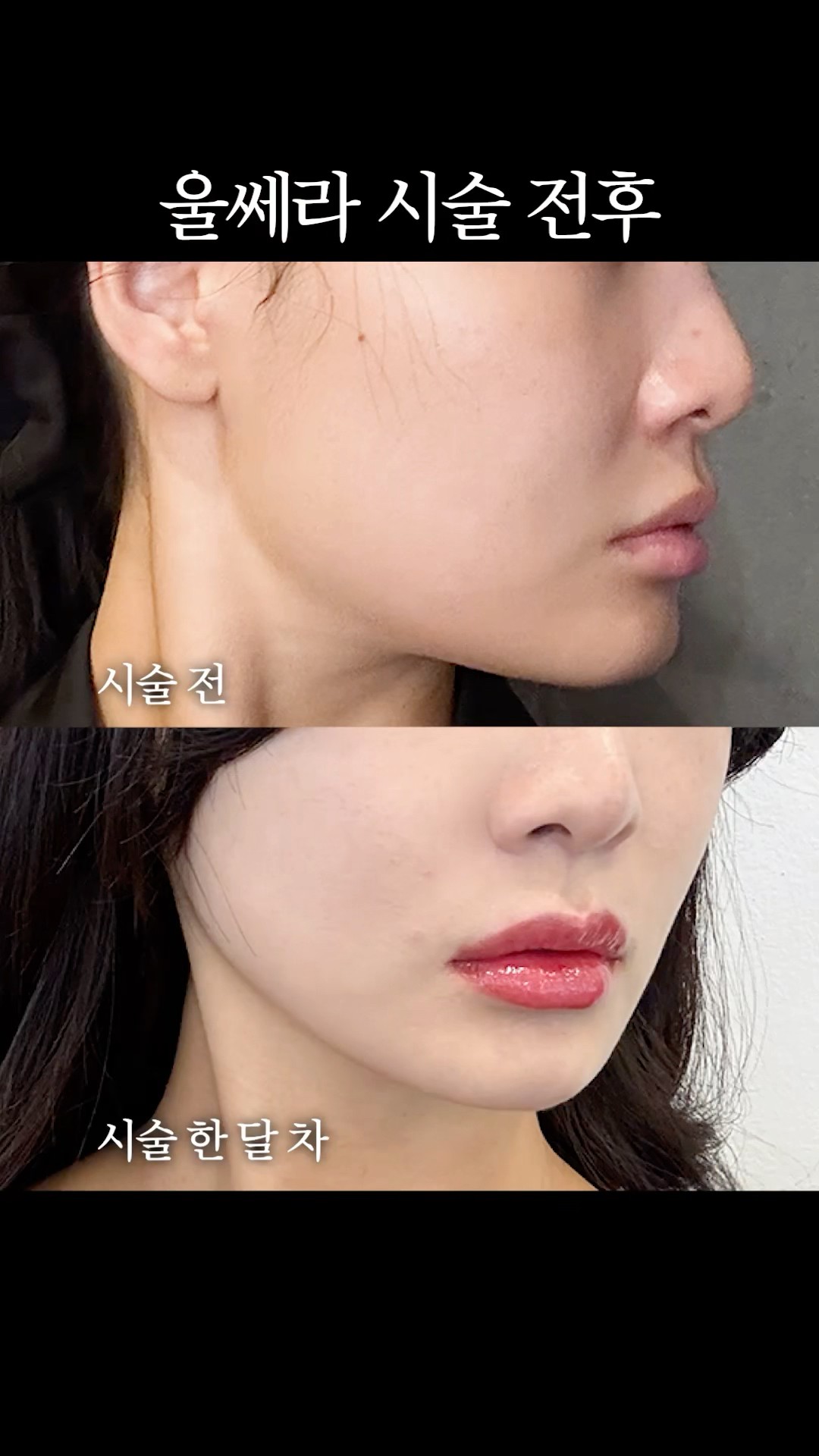 선명한 턱선을 원한다면? 💫