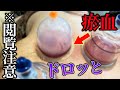 【閲覧注意　瘀血肩甲骨はがし】瘀血が肩甲骨の中からドロっと出ました　吸い玉肩甲骨はがし鍼はこれが効く　自宅でできる方法も伝授　【東京銀座　横浜元町　鍼灸院】