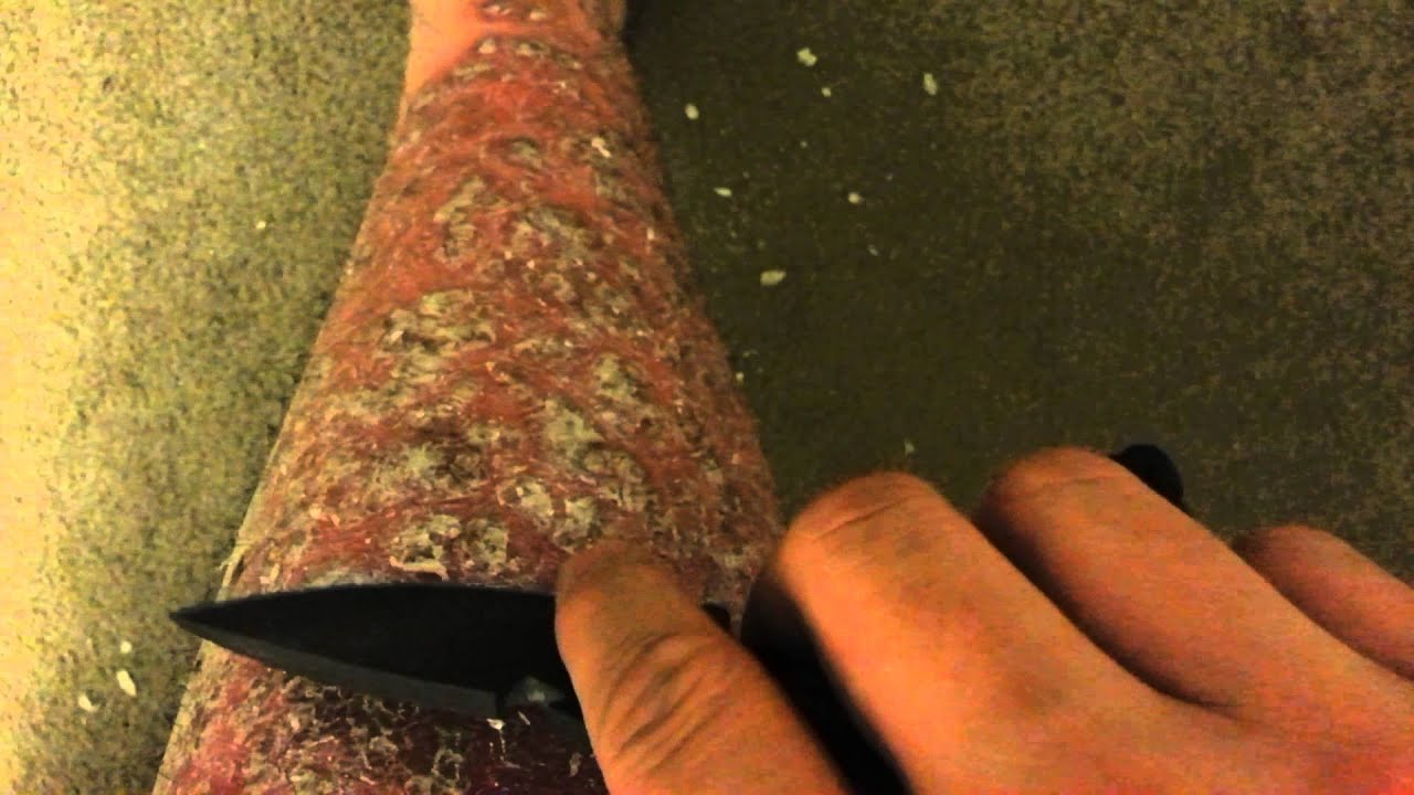 Psoriasis peel n scrape part 1 - YouTube