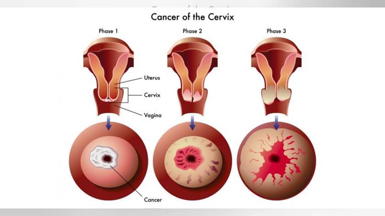 Rak Szyjki Macicy YouTube rak-szyjki-macicy-youtube