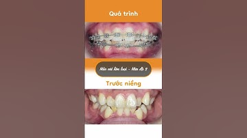 Hành trình LỘT XÁC nhờ niềng răng của Phương Thắm