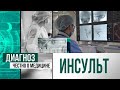 Что такое инсульт и что нужно о нём знать | Диагноз