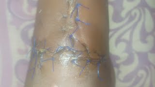 Dressing the patient who had leg vein cut See video for details