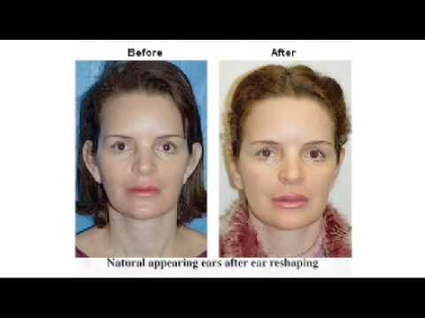 Video de otoplastia y remodelación de las orejas
