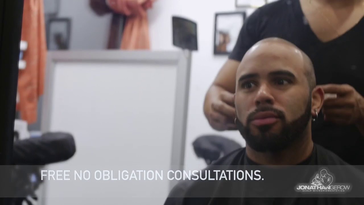 Get Your Hairline Back With ScalpMicropigmentation YouTube
