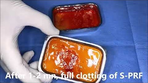 Sticky bone: Bone graft in a sticky form with PRF - Platelet Rich Fibrin for dental use