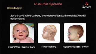 Cri-du-Chat Syndrome - Usmle step 1 lecture