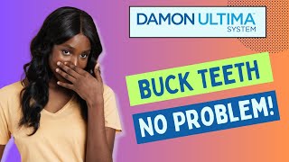 Detailed Buck Teeth No Problem with Damon Ultima Braces Profile