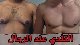 كيف تتخلص من التثدي عند الرجال...