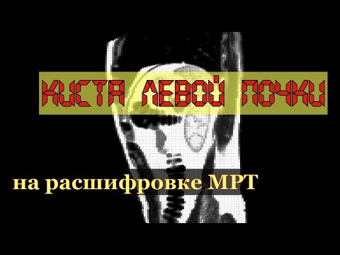 Признаки КИСТЫ ЛЕВОЙ ПОЧКИ Bosniak 1 на расшифровке МРТ брюшной полости