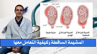 المشيمة الساقطة النازلة وكيفية التعامل معها د / محمد بدر يجيب