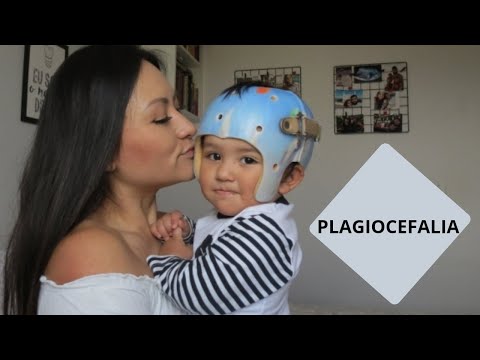 Vídeo: Por Que Os Bebês Usam Capacetes? Perguntas Frequentes Sobre Terapia Com Capacete Médico