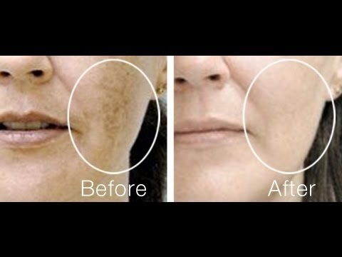 Clear Acne Scars,Remove Dark Spots ,Home Remedy for Black Spots on Face