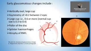 PRIMARY OPEN ANGLE GLAUCOMA BY DR SANKALP OPTHAL