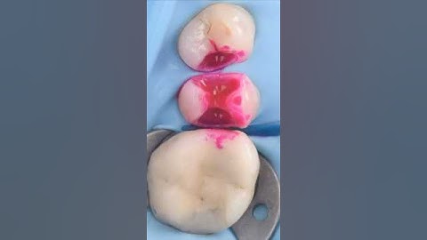 Klasse 2 restauratie met behulp van het sectionele matrixsysteem van Garrison