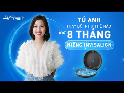 8 Tháng niềng răng trong suốt Invisalign -Tú Anh đã thay đổi thay đổi thế nào?