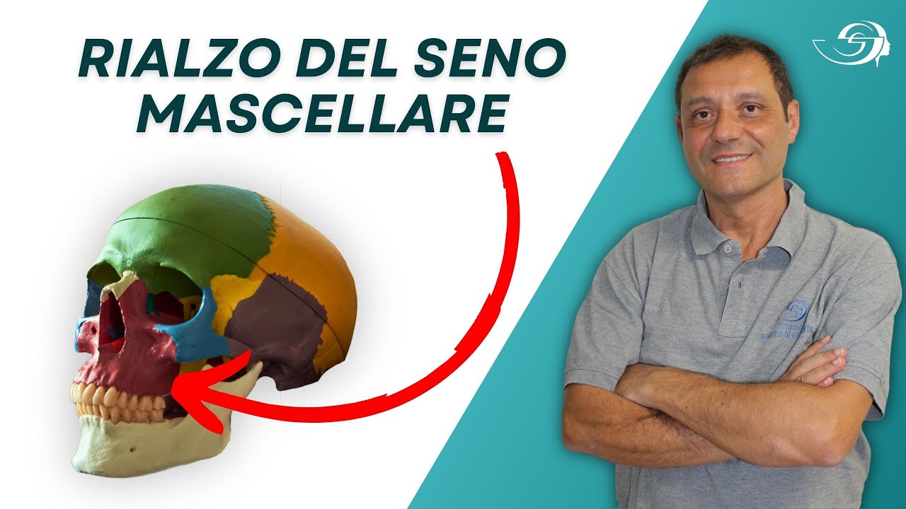 Rialzo del Seno Mascellare: Tecniche e Benefici per gli Impianti Dentali