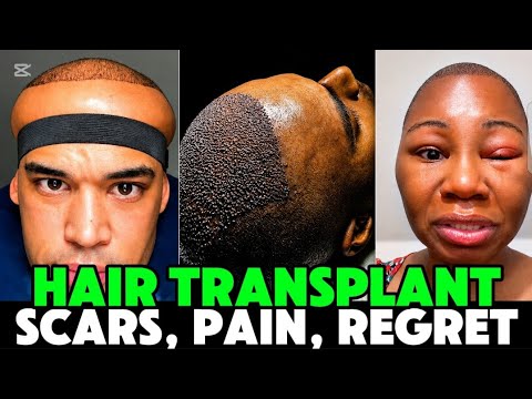 The Painful Truth About Hair Transplants NOBODY Tells You