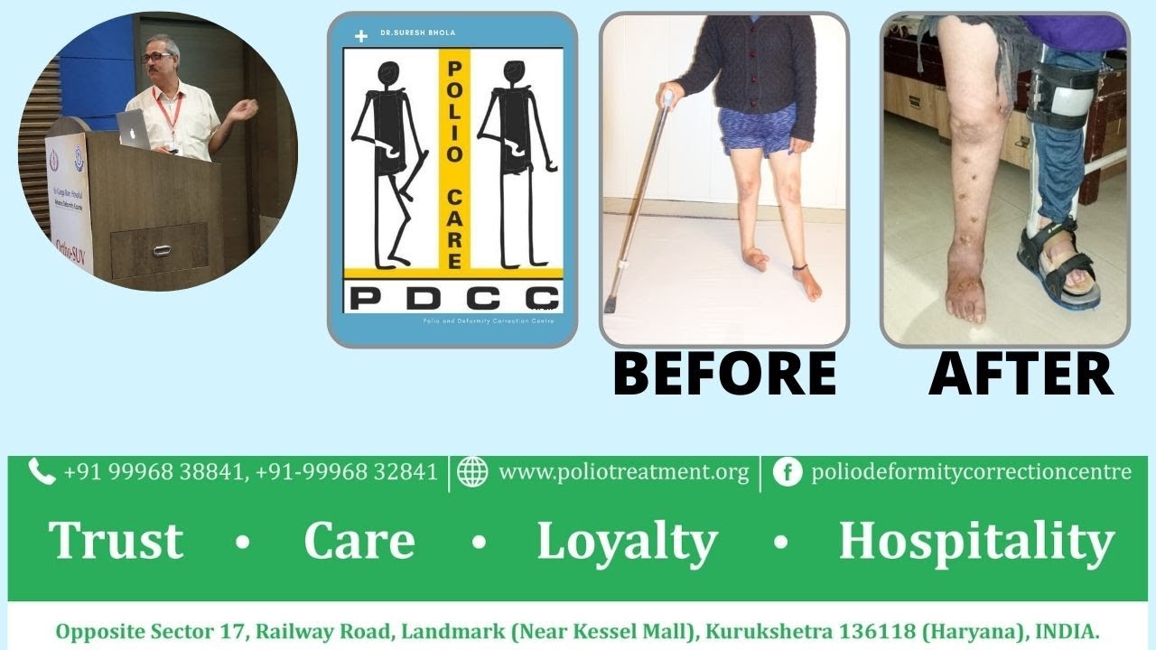 Best polio treatment in India 46 साल की उम्र , दोनों टांगें पोलियो से ग्रस्त, ईलाज से जीवन में सुधार