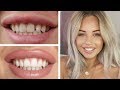 HOW I FIXED MY TEETH ON A BUDGET | Lucy Jessica Carter