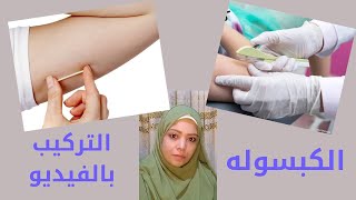 بالفيديو ..تركيب كبسولة منع الحمل (امبلانون نكست)مع د/دعاء حمزه