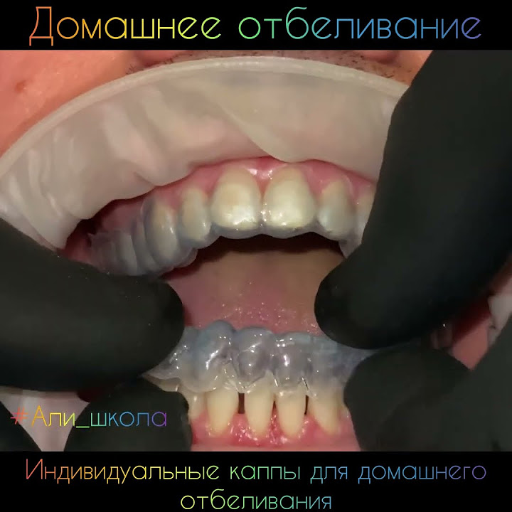 Домашнее отбеливание зубов. Каппы для отбеливания зубов. #Али_школа ...
