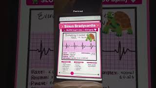 Are you preparing for the NCLEX? Here’s what you NEED to know about normal sinus rhythm, bradycardia