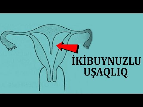 Video: İkibuynuzlu uşaqlıqda hamilə qalmaq şansı nədir?