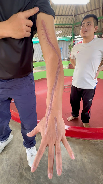 He Survived Multiple Bites from a Cobra! #shorts #kingcobra #snake #bite #phuket #ahas
