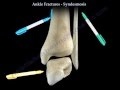 Ankle Fractures and the Syndesmosis - Everything You Need To Know - Dr. Nabil Ebraheim