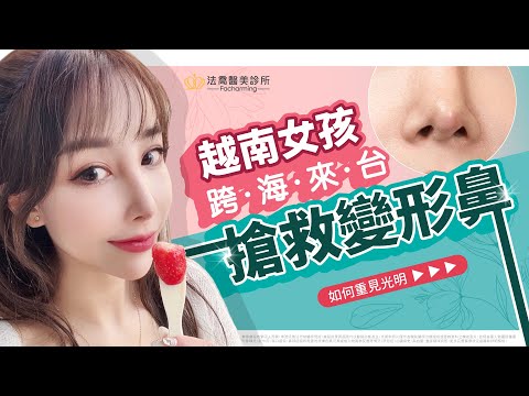 越南女孩跨海來台搶救變形鼻！悚！原本快穿出的隆鼻假體 靠自體肋骨隆鼻重建光明！ - 法喬醫美診所邱浚彥醫師衛教案例