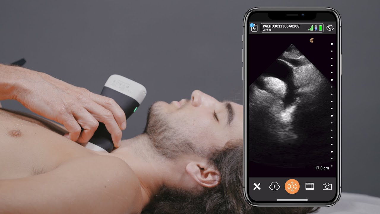 PAL Suprasternal Notch View